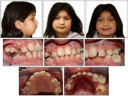 Cherubism symptoms, a rare disease that affects around 200 people globally. Orthodontic Management Of A Patient With Cherubism A Case Report American Journal Of Orthodontics And Dentofacial Orthopedics