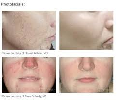 Lux Laser Hair Removal