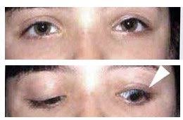 What does lid lag mean? Congenital Ptosis Drooping Eyelids The Elza Institute