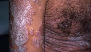 Image result for psoriasis