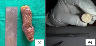 Image result for Tonsillolith