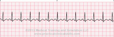 Arrhythmia Definition Practice Drills