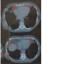 Image result for Pulmonary Intoxicant