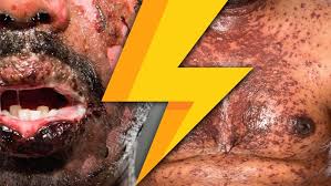 Introduction steven johnson syndrome (sjs) is a disorder of the skin and mucous membrane, induced by exposure to drugs or infections. Lightning Learning Stevens Johnson Syndrome Sjs Em3 East Midlands Emergency Medicine Educational Media