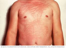 Image result for Dermatographism