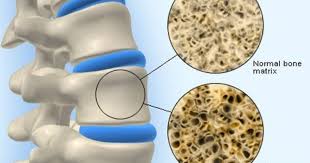 evidence based ways to increase bone density and build healthy bones including osteoporosis diet increase bone density osteoporosis diet healthy bones