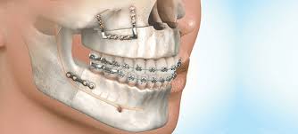 Oral & maxillofacial surgery our complete surgical staff has expertise not only for routine dental extractions, but also for complex jaw reconstruction. Best Oral Maxillofacial Surgeons Premier Hospital