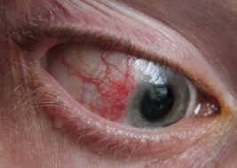 Image result for Acute Red Eye