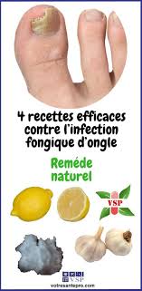4 Recettes Efficaces Contre L Infection Fongique D Ongle La Sante Naturellement Fongique Infection Fongique Infections Fongiques Des Ongles