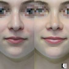 Before and After results from a Rhinoplasty! 📞Call (818) 986-7900 to book  a surgical consultation for more information! • • • #rhinoplasty  #facialplasticsurgery #beforeandafter #adrianyi #adrianyimd #encino  #encinoplasticsurgeon #cosmeticsurgery ...