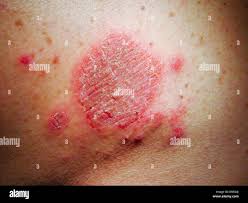 Image result for Eczema nummulare