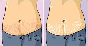 What People Don T Tell You About Stretch Marks And Pcos