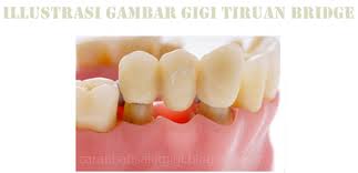 Gigi palsu adalah pengganti yang digunakan untuk mengisi gigi yang lepas dan jaringan di sekitarnya yang hilang, misalnya karena faktor usia. 6 Macam Jenis Gigi Palsu Permanen Lepasan Dan Bahan Yang Digunakan