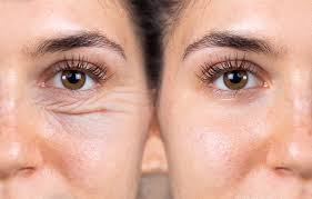 To help decide if blepharoplasty is right for you, find out what you can realistically expect and explore the benefits and risks of blepharoplasty. Blepharoplasty Center For Sight