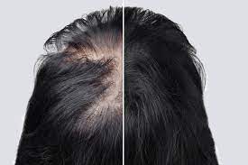And by the way, the ibuprofen you are taking for arthritis could be raising your blood. Understanding The Different Types Of Hair Loss Ds Healthcare Group