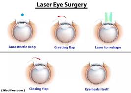 How much does lasik surgery really cost? Can You Have Laser Eye Surgery Done More Than Once Quora