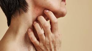 Image result for Dry Skin