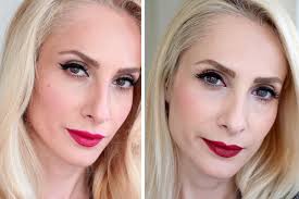 Sebi Bebi Isik Dolgusu Botox Ve Dudak Dolgusu Deneyimi