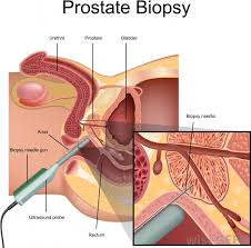 Most likely, if you live long enough. What Are The Different Types Of Prostate Cancer Tests