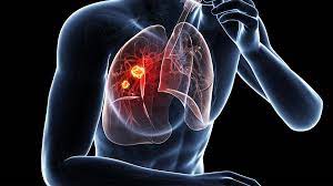 Exposure to environmental tobacco smoke among. Lung Cancer Signs Symptoms Types And Staging