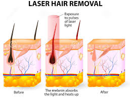 Saves you time & money because you won't have to shave or wax. Laser Hair Removal Toronto Downtown Baywood Laser Clinic
