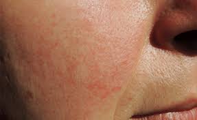 Weitere ideen zu rosazea, rosacea pflege, rosacea behandlung. Redness Sensitivity How To Soothe Treat Rosacea Blog Huda Beauty
