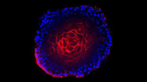 To take part in the study, the participants (90% white and 6% black) had to have very. Revealing A Potential New Marker For Aggressive Prostate Cancer