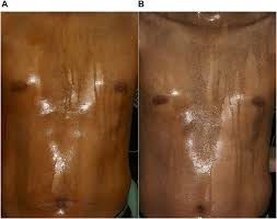 Image result for Anhidrosis