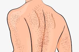 Mi padre lo diagnosticaron con purpura trombocitopenia, sus plaquetas llegaron 15.000 estuvo. Purpura Trombocitopenica Idiopatica Sintomas Causas E Tratamento Tua Saude