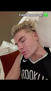 Double chin lipo process ✅👍🏻😇#chinlipo #lipopapada #fy #doublechin  #fypage