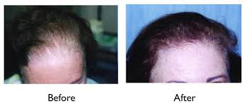 According to the american hair loss association, those who struggle with the effects of this condition are affected professionally, socially, and emotionally. Female Hair Loss Causes Diagnoses And Treatment New York