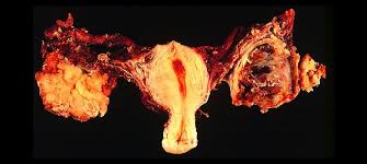 Gonadal radiation and the oophoritis of mumps are possible examples of environmental risk factors for early menopause and ovarian cancer. Decisions On A Knife Edge The Dilemma About Surgery To Ward Off Ovarian Cancer