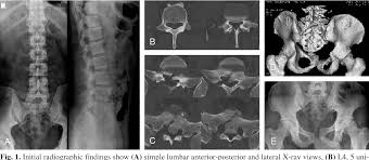 Thoracic transverse process fractures (ttpfs) are injuries that go unnoticed during traditional autopsies, as demonstrated by a lack of medicolegal publications regarding ttpfs. Figure 1 From Reduction Without Fusion Of Bilateral Jumped Lumbosacral Facet Dislocation Associated With Symphysis Pubis Separation And Cauda Equina Syndrome Case Report Semantic Scholar