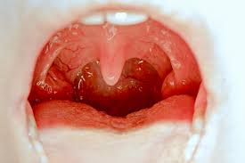 Trouble swallowing is one of the early reported warnings signs and symptoms of throat cancer. 16 Known Signs Of Throat Problems