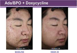 Top Ten List of Clinical Pearls in the Treatment of Acne Vulgaris