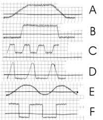 Intermittent Fever Wikipedia