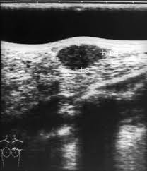 Raumforderungen Der Brust Brustknoten Gynakologie Und Geburtshilfe Msd Manual Profi Ausgabe