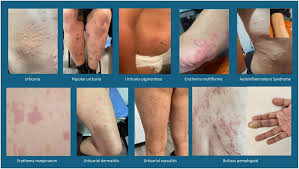 Image result for Papular urticaria
