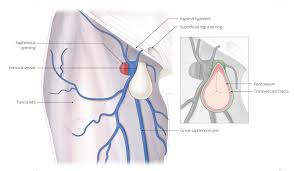 This may include pain or discomfort especially with coughing, exercise, or bowel movements. Femoral Hernia Amboss