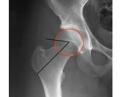 Image result for Hip XRay