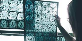 Food and drug administration has resigned in protest over the agency's decision to approve biogen's alzheimer's disease treatment despite the committee's recommendation against doing so. Biogen S Aduhelm Approval Faced Opposition Within Fda