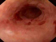 Candida wont present with a visible ulcer, it'll have candidial growth on top(duh! Gi 11 Pathology Of The Esophagus Flashcards Cram Com