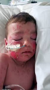 Stephen johnson on wn network delivers the latest videos and editable pages for news & events, including entertainment, music, sports, science and more, sign up and share your playlists. Toddler Nearly Dies After Contracting Rare Skin Condition Steven S Johnson Syndrome Daily Mail Online