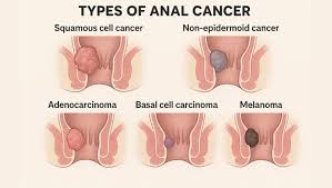 Image result for Anal Cancer