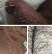 Read about oral herpes symptoms, outbreak stages, signs, treatment, transmission, and prevention. Prompt Treatment Of Disseminated Hsv 2 Infection In A Patient With Compromised Cellular Immunity A Case Of Aborted Hemophagocytic Lymphohistiocytosis Tsimpidakis 2020 Clinical Case Reports Wiley Online Library