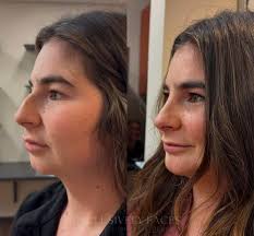 VERY early rhinoplasty & chin implant results ✨ we just couldn't wait to  share! Abigail, our beautiful aesthetician, is pictured before and just 2  weeks after a rhinoplasty and chin implant! She