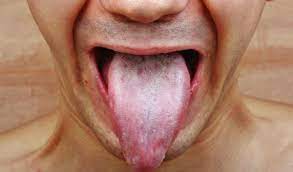 Como Quitar El Ardor En La Lengua Remedios Muy Efectivos
