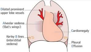 Epidemiology and outcomes of cardiac arrest. Cardiac Heart Failure Made Easy Pathophysiology And Diagnosis Epomedicine