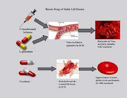 Sickling disorders include heterozygous (as) sickle cell trait, homozygous (ss) sickle cell disease, compound heterozygous states for hbs with haemoglobins c, d, e, or other structural variants and the combination of the sickle cell gene with different forms of thalassaemia. Efficacy And Safety Of Recently Approved Drugs For Sickle Cell Disease A Review Of Clinical Trials Experimental Hematology