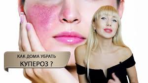 как убрать сосудистую сетку на лице в домашних условиях Sosudistaya Setka Kuperoz Kak Ubrat Doma Prichiny Resheniya Youtube